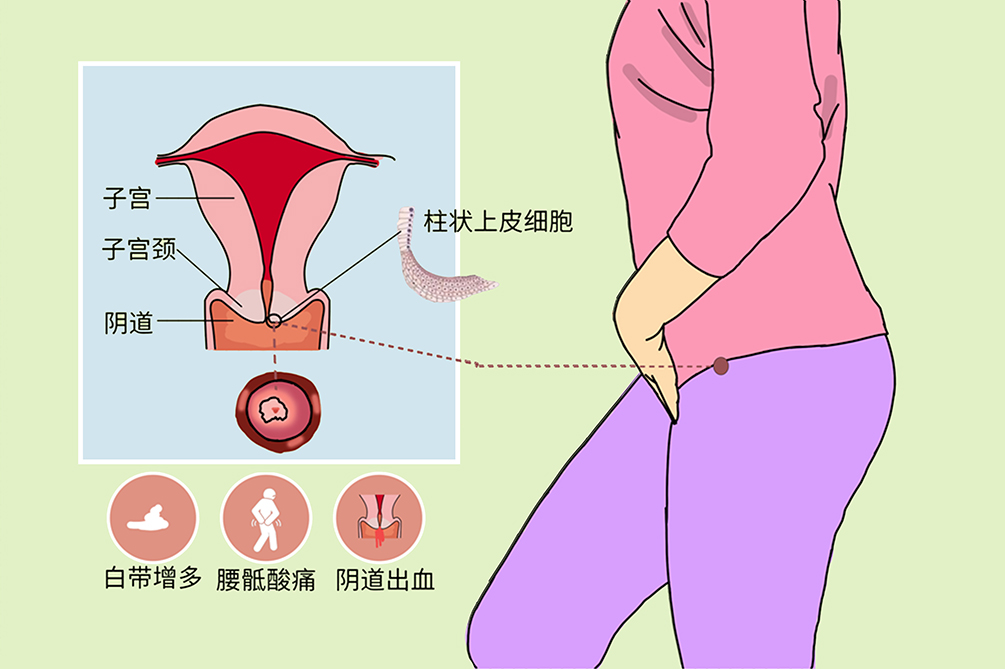 宫颈糜烂图片,宫颈糜烂症状,宫颈糜烂原因,宫颈糜烂治疗