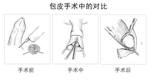 包皮过长危害,包皮过长图片,包皮过长早泄,包皮过长原因