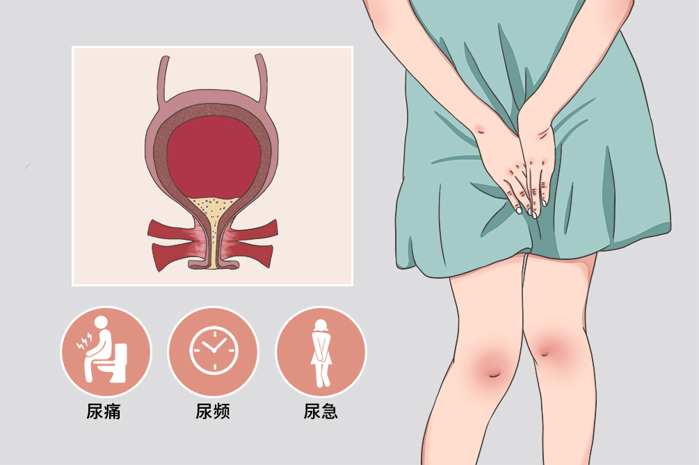 尿道炎症状,尿道炎女性,尿道炎用药,尿道炎治疗